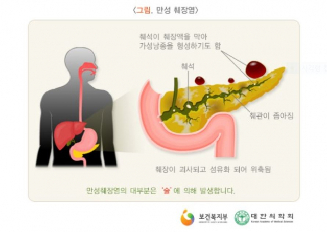 만성 췌장염 20~30％ 암 발병 가능성-13-2.jpg