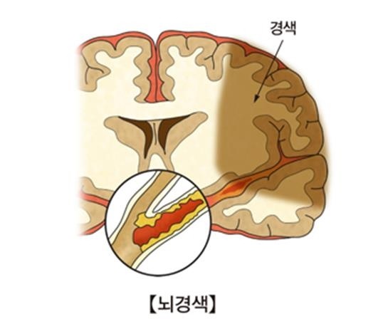 뇌경색 실어증, 성악 듣기 도움된다-24.jpg